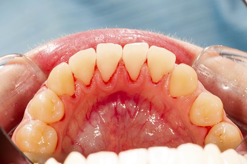 Teeth-and-irritated-gums-close-up-gum-disease