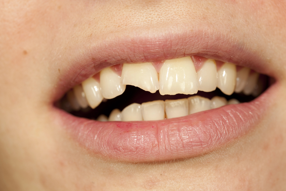adult chipped a tooth in an accident